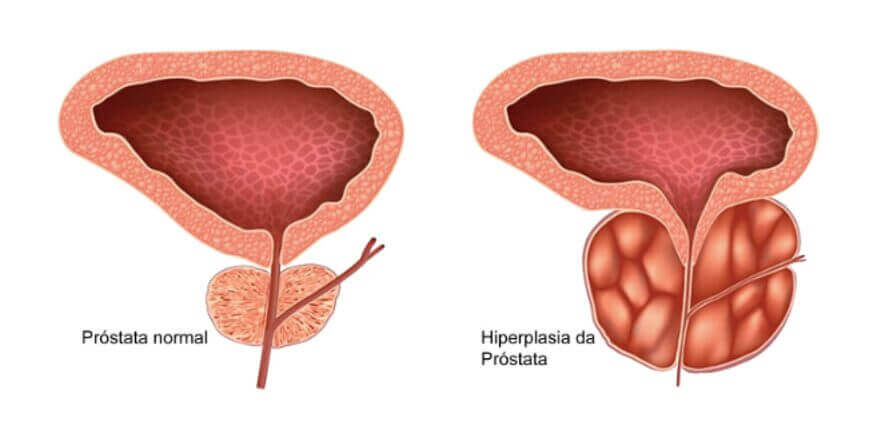 Hiperplasia Da Pr Stata Dicas Para Uma Pr Stata Saud Vel Dr Felipe