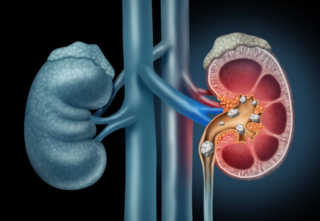 ureterorrenolitotripsia flexível a laser