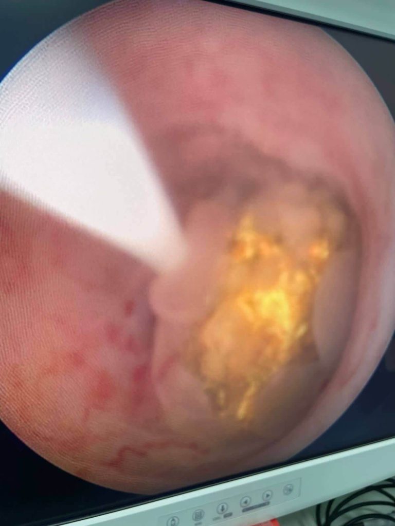Ureterorrenolitotripsia Flexível a Laser
